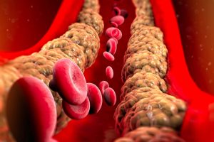 colesterol-arterias-1024x683