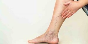 trombosis-venoso-flebitis