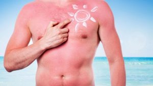 bigstock-quemadura-solar-768x432